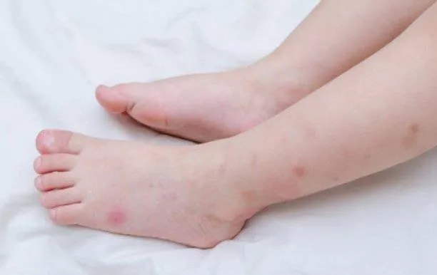 Dấu hiệu sốt xuất huyết trẻ em cần nhận biết sớm